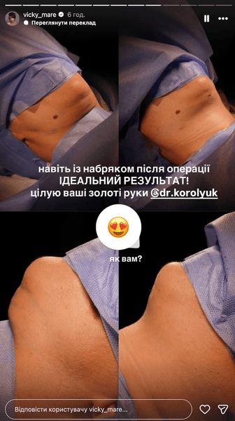 Маремуха пластина операція підборіддя